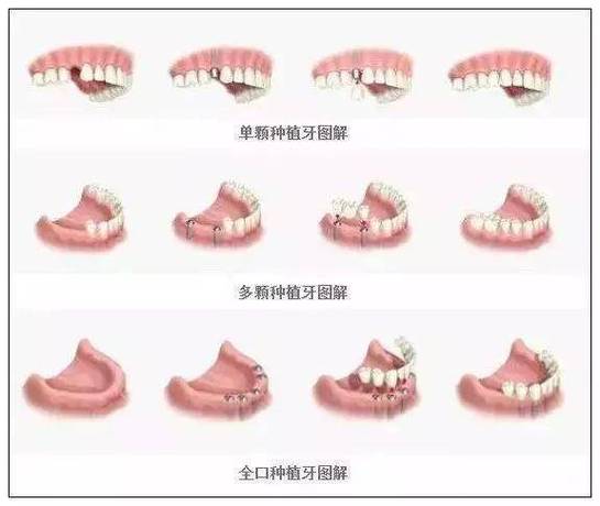 广州半口种植牙全过程要多久?疼不疼?一步步讲清楚