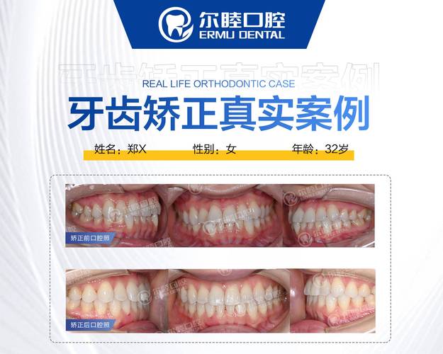 广州成人矫正牙齿咬合疼不疼?效果和费用全解析