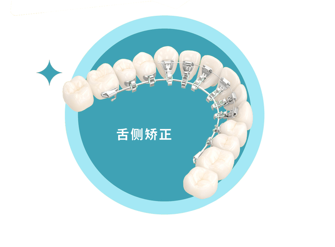 广州成年人牙齿舌侧正畸到底值不值?看完这几点就懂了