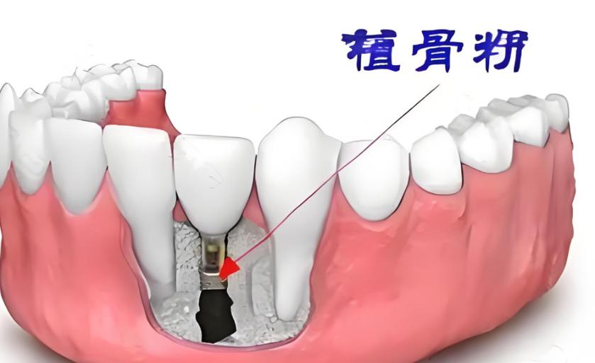 广州5000元的种植牙靠谱吗