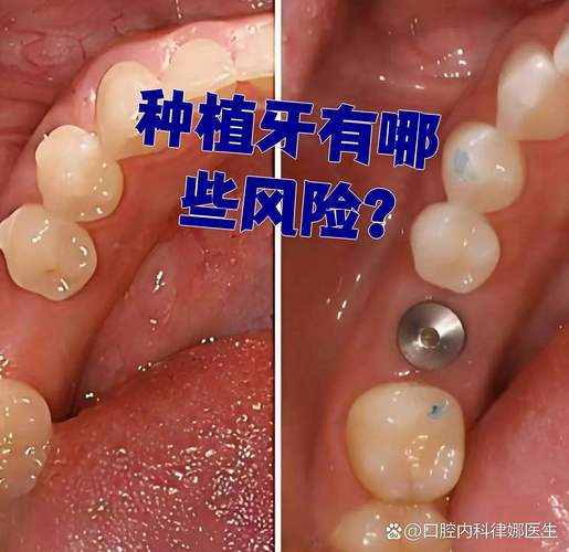 广州全口种植牙的风险和后遗症有哪些