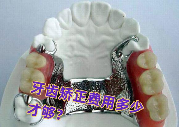 广州长沙矫正牙齿费用一览:从几千到几万差在哪