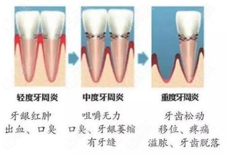 广州深圳牙周炎治疗到底要花多少钱?2026最新费用解析