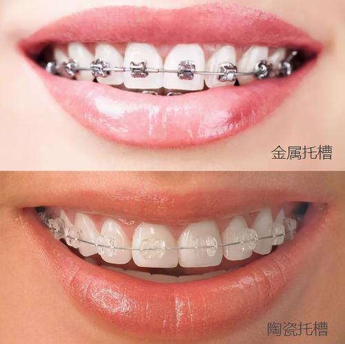 广州深圳深覆合矫正费用大揭秘:到底多少钱才靠谱?