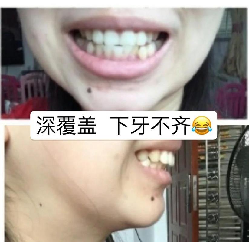 广州39岁牙齿矫正还有用吗 真实效果看这里