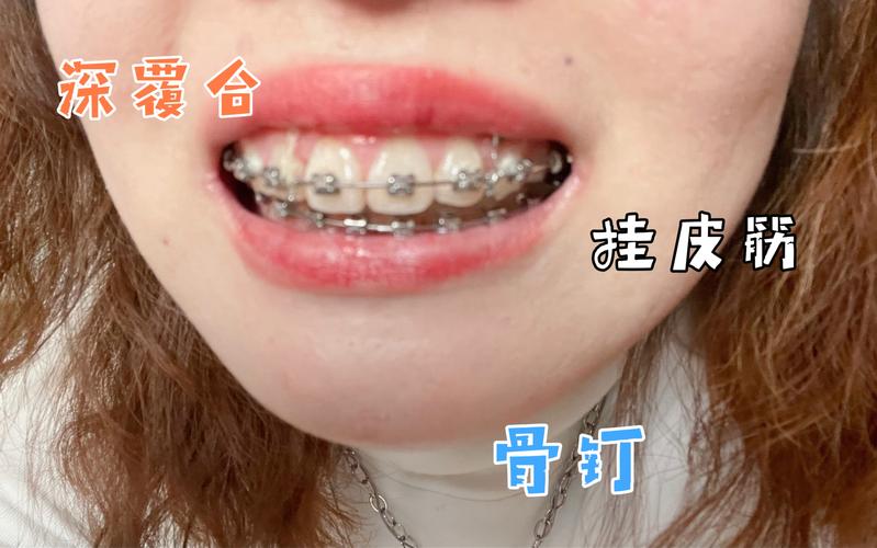 广州深圳深覆合正畸去哪家好？牙科推荐避坑指南